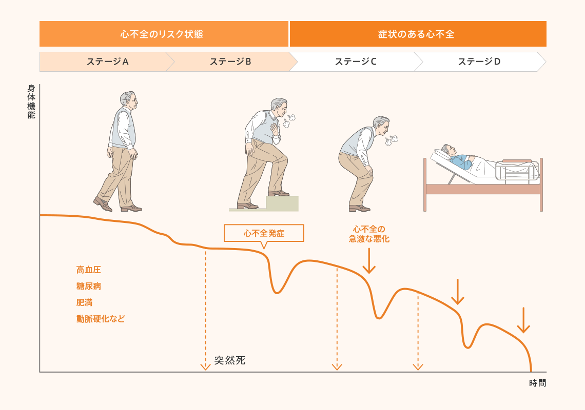 心不全のステージイラスト